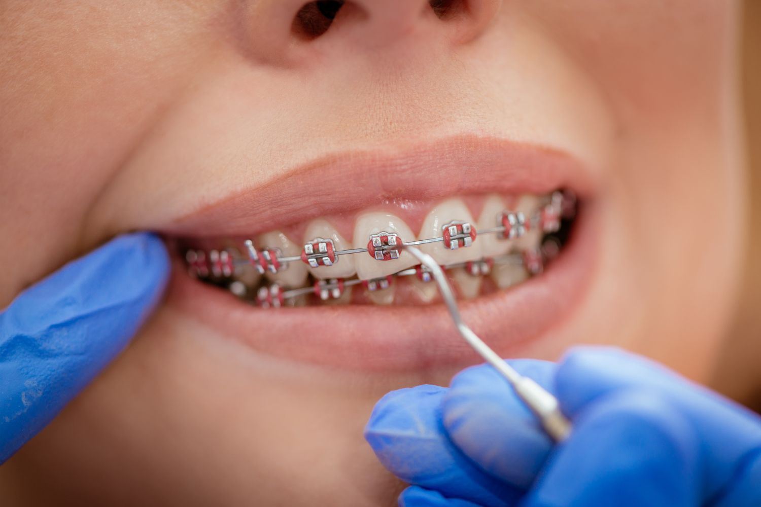 The Cost of Braces for Adults: Is the Investment Worth It?