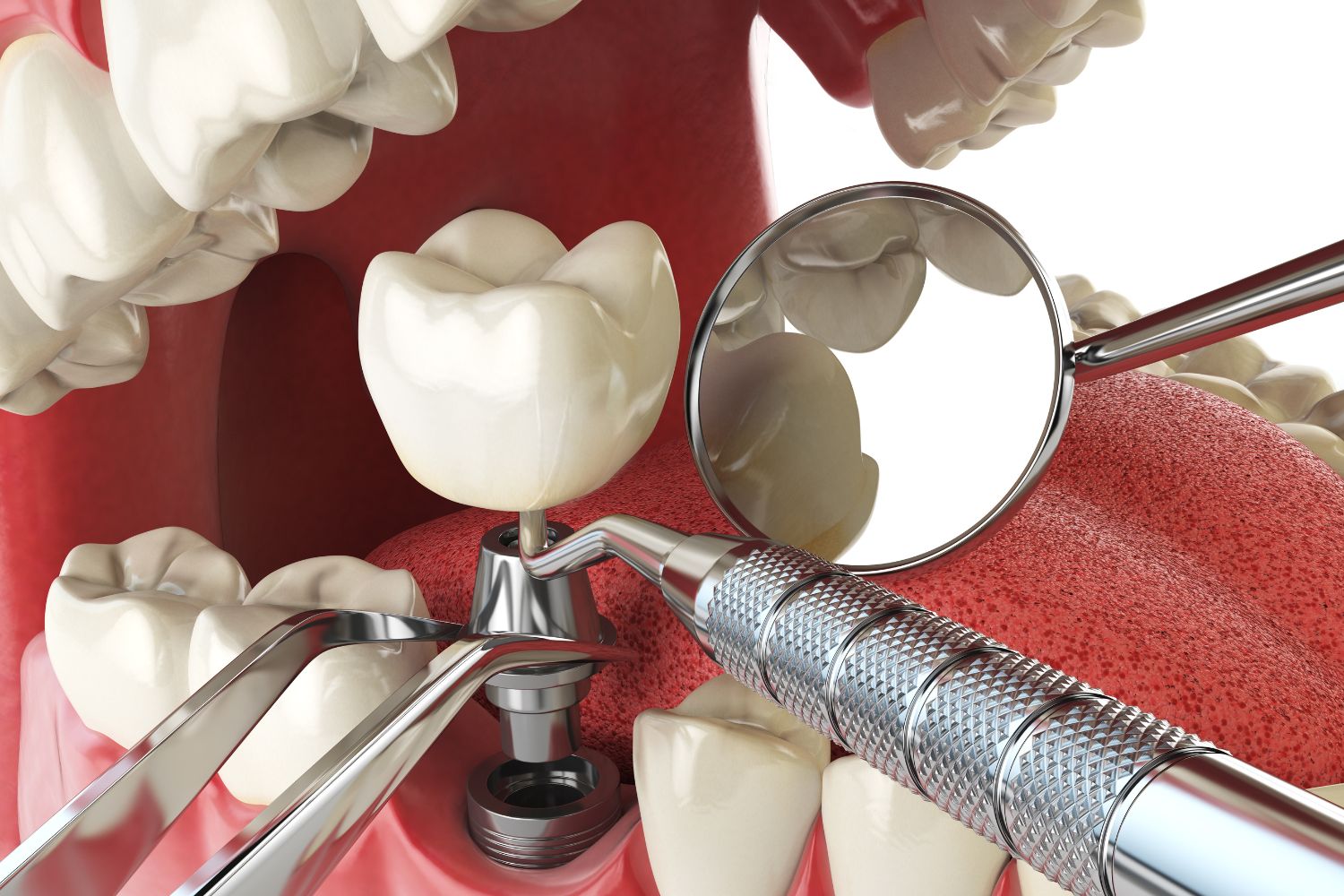 Dental Implant Options: Which One is Right for You?
